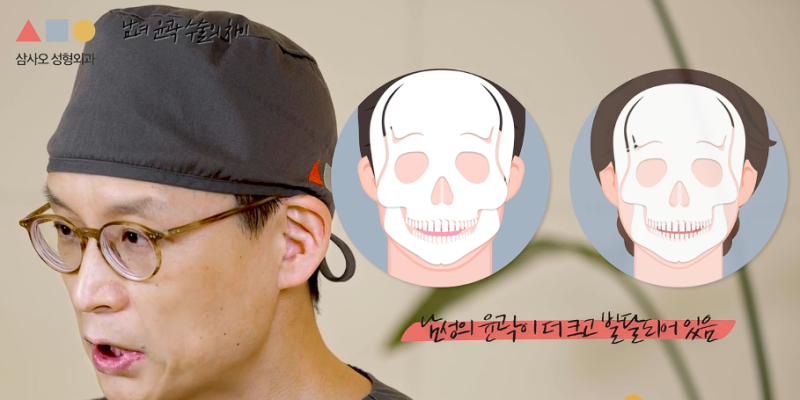 남자 윤곽수술, 여자와 뭐가 다를까? 뼈박사가 알려드립니다! 사진 2