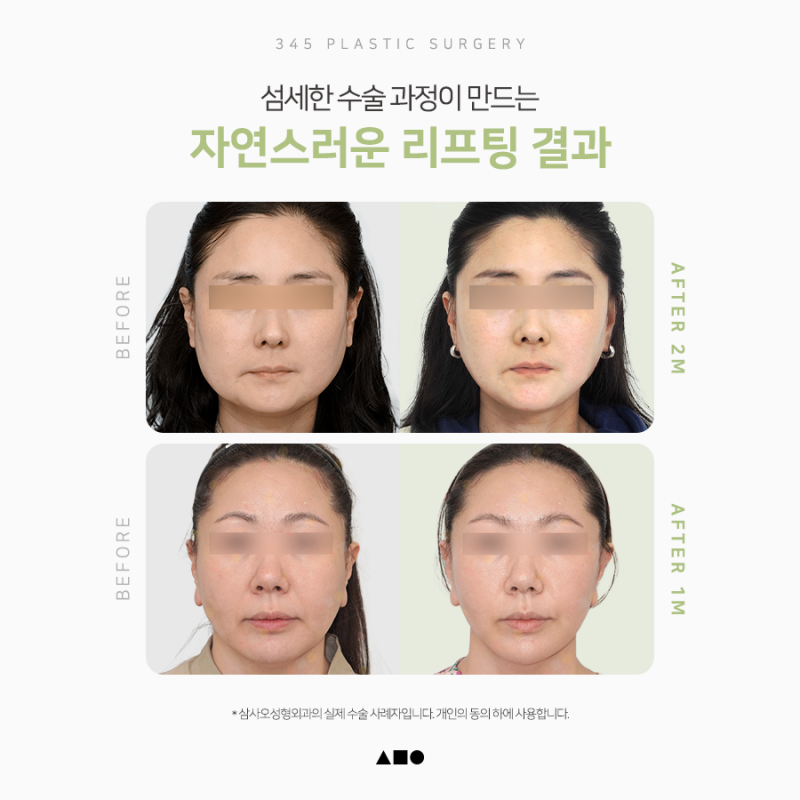 SMAS 볼륨거상, 처짐과 꺼짐을 함께 개선하려면 사진 6