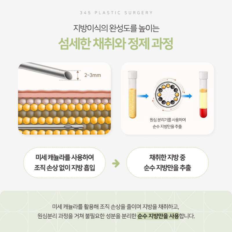 SMAS 볼륨거상, 처짐과 꺼짐을 함께 개선하려면 사진 4