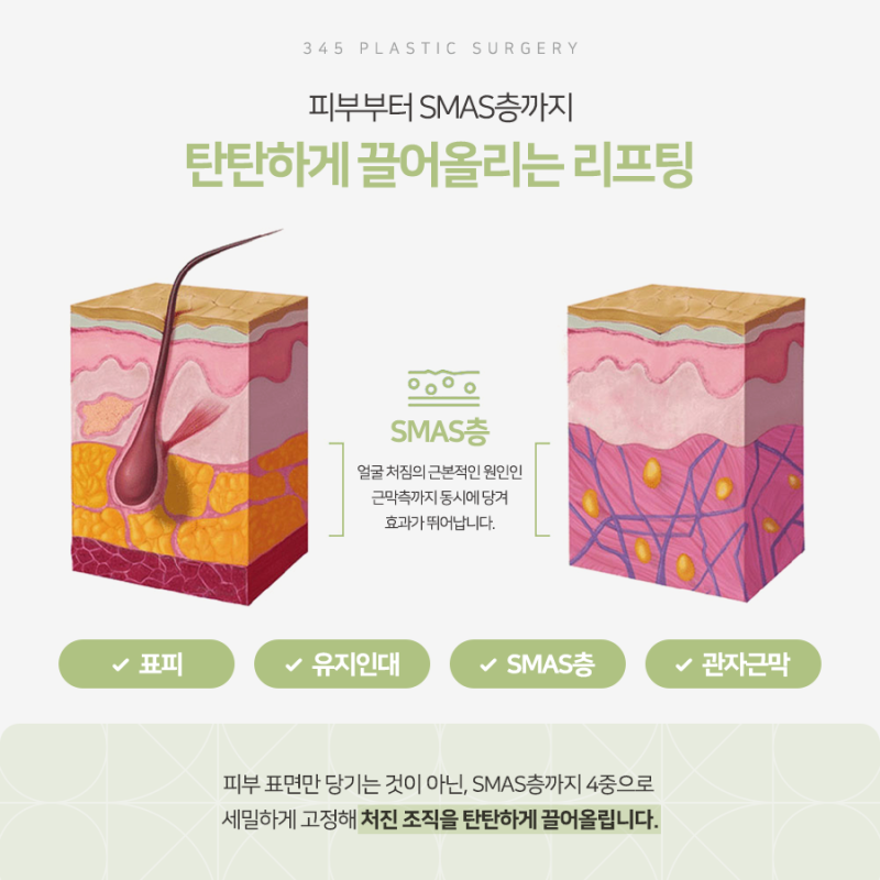 SMAS 볼륨거상, 처짐과 꺼짐을 함께 개선하려면 사진 3