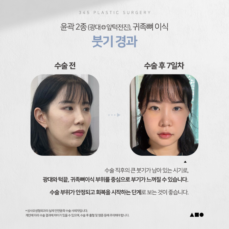 20대 여성 윤곽 2종 (광대, 사각턱) 리얼 붓기 변화
