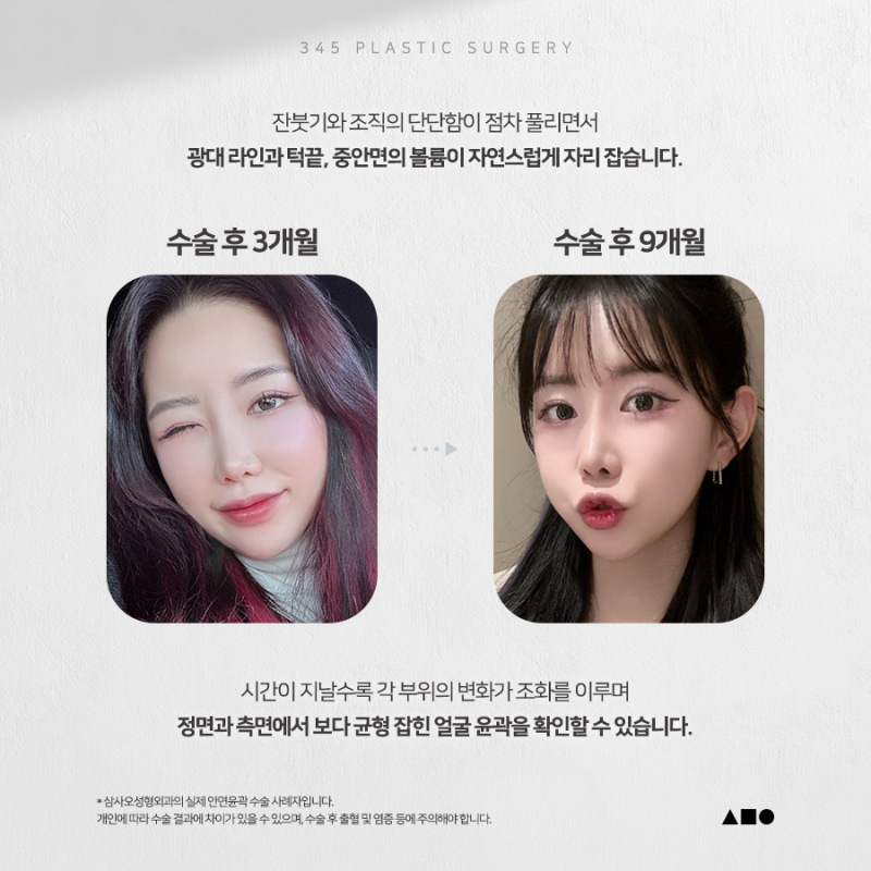 20대 여성 윤곽 2종 (광대, 사각턱) 리얼 붓기 변화 사진 5
