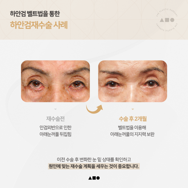 하안검수술, 재수술이라면 더 꼼꼼하게 살펴봐야 하는 이유 사진 6