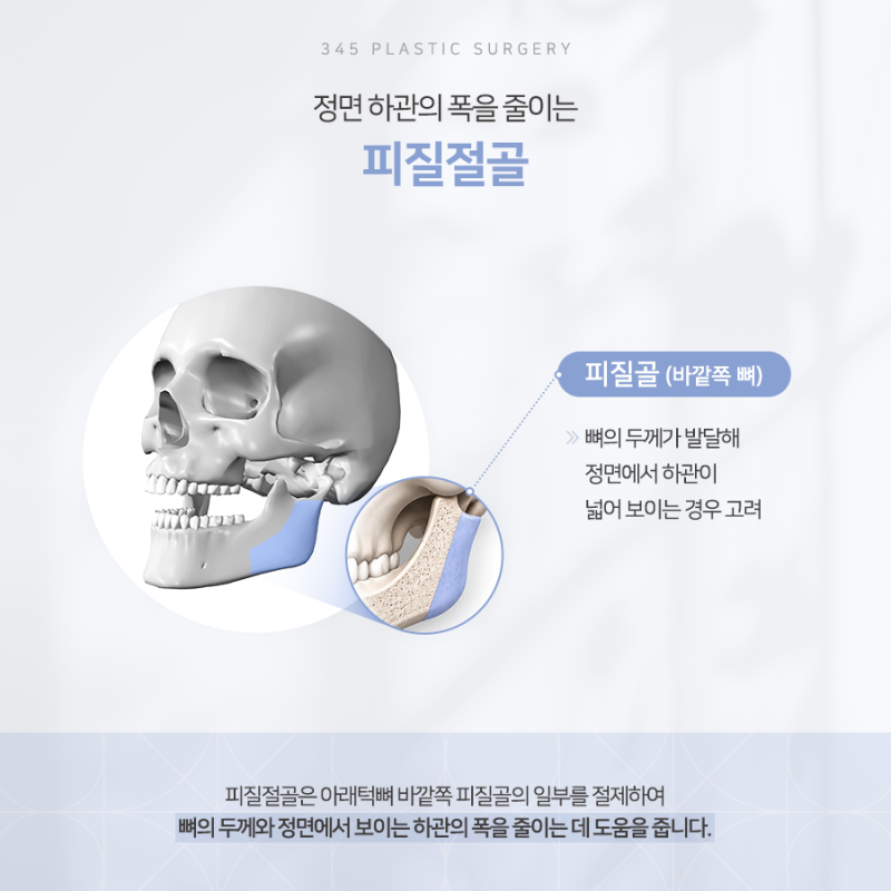 사각턱 수술, 뼈만 줄이면 될까요? 피질절골, 교근축소, 협부지방제거 사진 4