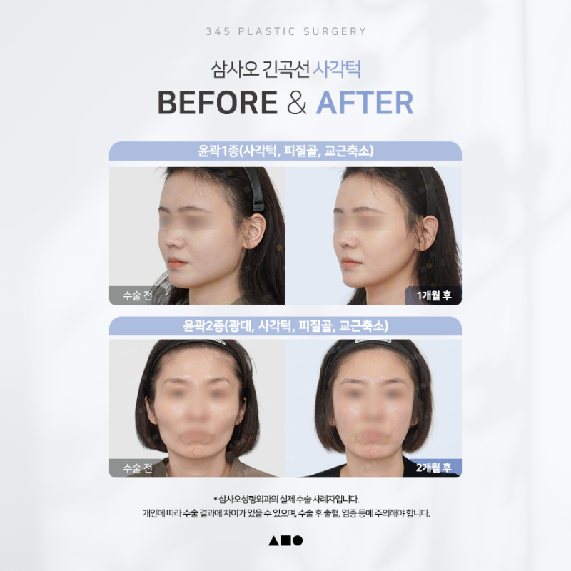 사각턱 수술, 뼈만 줄이면 될까요? 피질절골, 교근축소, 협부지방제거 사진 7