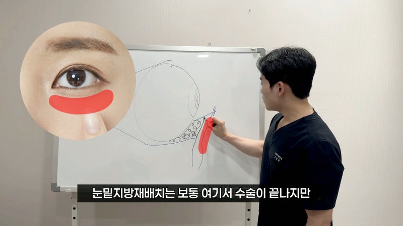 부산눈밑지잘하는곳 찾는다면 눈밑지와 사시 관계 정리!