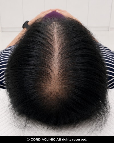 앞머리 탈모, 갱년기 여성이라면 지금 확인해 보세요. 사진 2