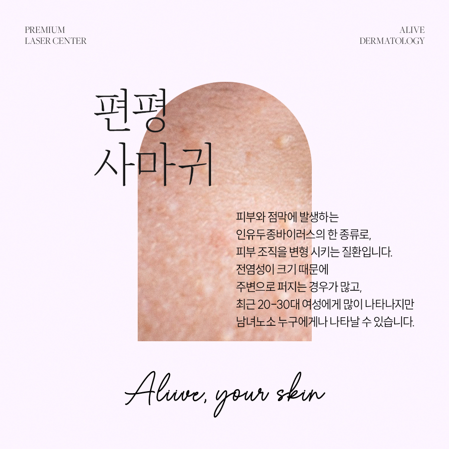 서초편평사마귀 흉터없이