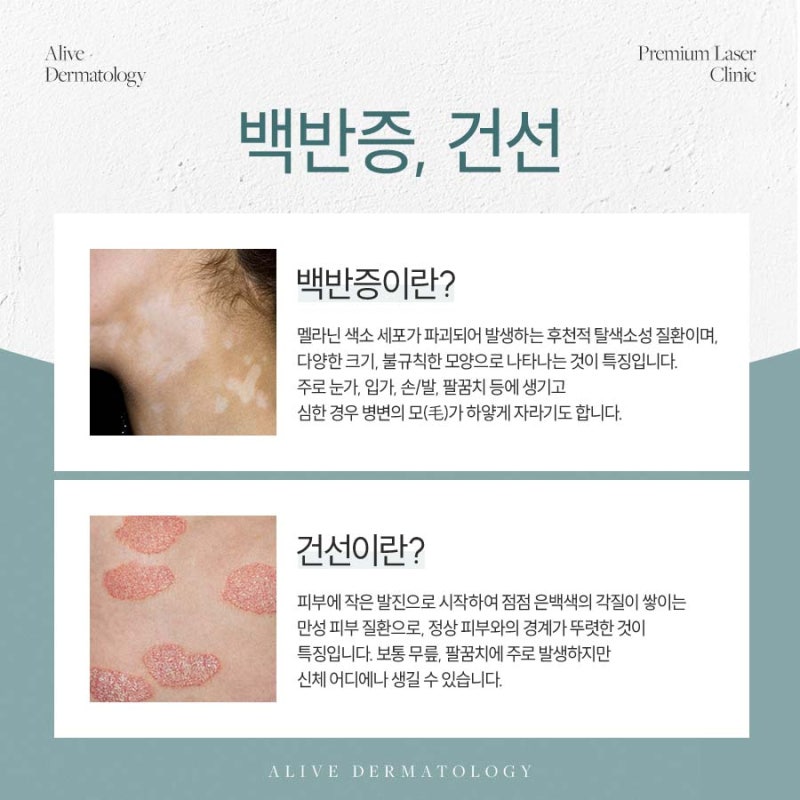 반포동백반증으로 자존감이 낮아지고 있어요.