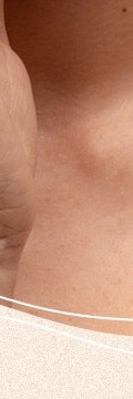 반포사마귀치료, 초기에 정확히 관리해야 하는 이유 사진 19