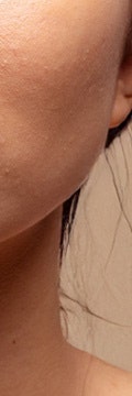 반포사마귀치료, 초기에 정확히 관리해야 하는 이유 사진 11
