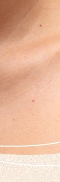 반포사마귀치료, 초기에 정확히 관리해야 하는 이유 사진 20