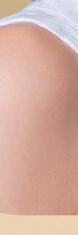 서초흉터치료, 다양한 흉터 유형 사진 28