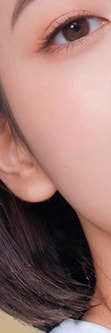 서초흉터치료, 다양한 흉터 유형 사진 19