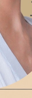 서초흉터치료, 다양한 흉터 유형 사진 30