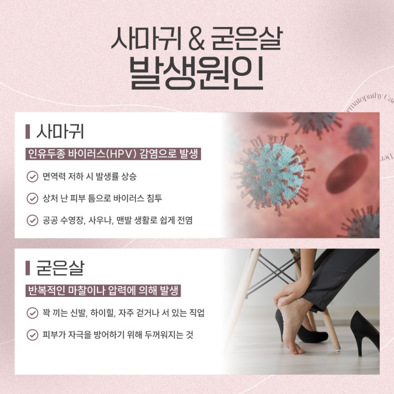 굳은살인 줄 알았는데… 고속터미널역사마귀 의심해야 하는 이유