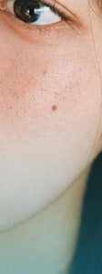 서초 기미 치료, 제대로 효과 보기 위해서는? 사진 20
