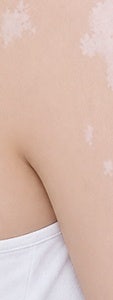 서초 백반증, 흰 반점이 보인다면 먼저 확인해야 할 것들 사진 24