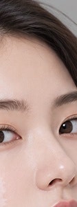 서초 백반증, 흰 반점이 보인다면 먼저 확인해야 할 것들 사진 9