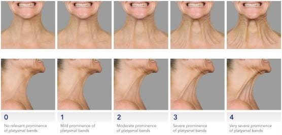 목주름-1편. 네페르티 주름 (Nefertiti line / Nefertiti neck line)