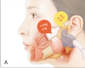 사각턱 보톡스 맞았는데 얼굴이 그대로라면?