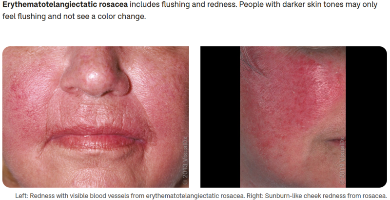 주사피부염(Rosacea)이란 무엇일까?