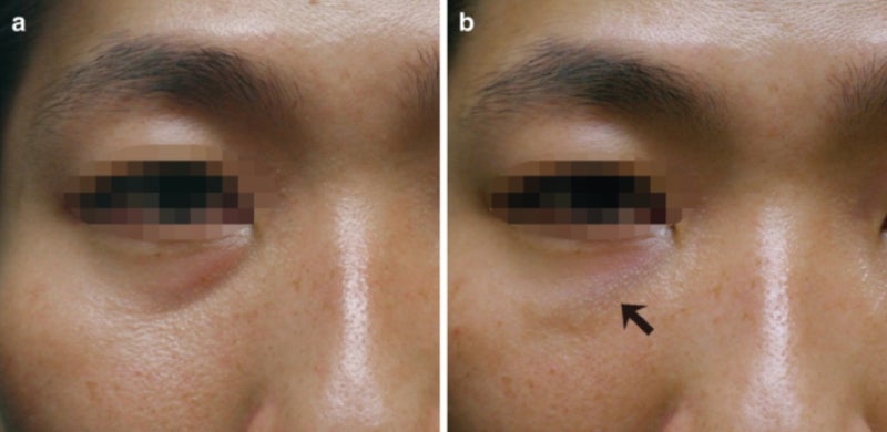 눈밑꺼짐 & 눈밑지방돌출 4탄 - 왜 어떤 사람은 예쁘고, 어떤 사람은 어색할까