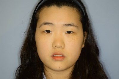 답답한 눈매를 길고 시원하게! 에이펙스성형외과 하모니앞트임!