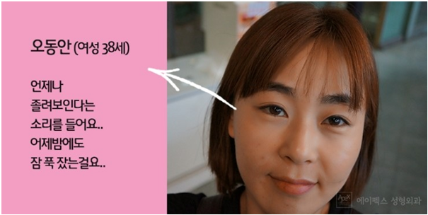 비절개눈매교정? 에이펙스성형외과!
