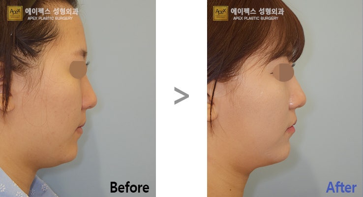아큐스컬프로 나도 브리라인~~