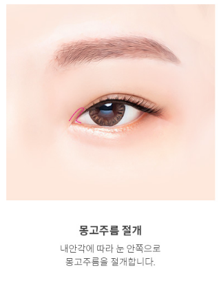 에이펙스성형외과 트임성형, 가로 세로 길이 확장으로 시원한 눈매 사진 7