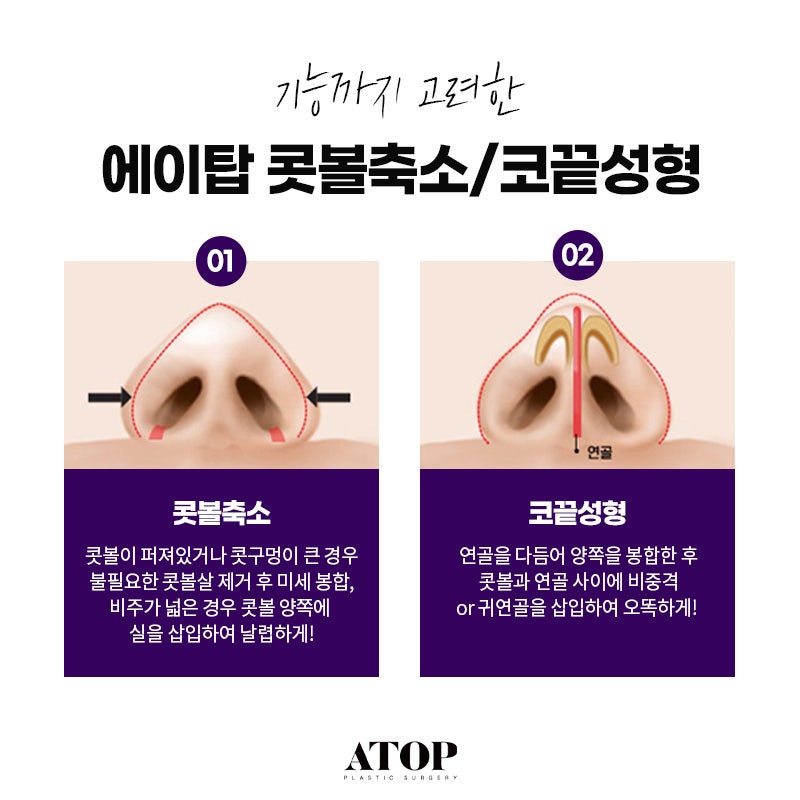 콧볼축소수술방법 원인을 먼저 파악해야 하는 이유