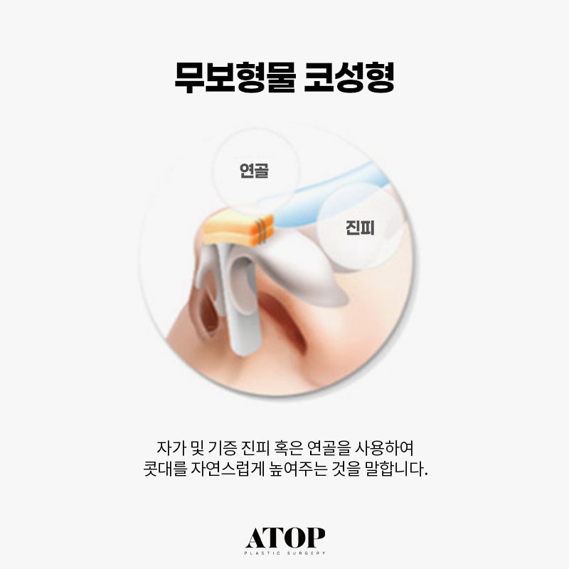 무보형물 코성형 만족도가 떨어질까?
