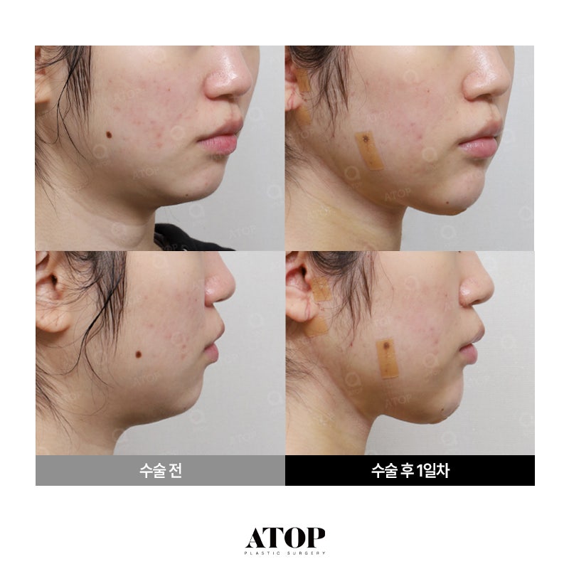 얼굴지방흡입 전후 차이, 라인 도드라지는 시기는?