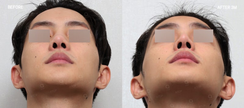 Nâng mũi chức năng: Lý do cần cân nhắc cả dáng mũi lẫn đường thở