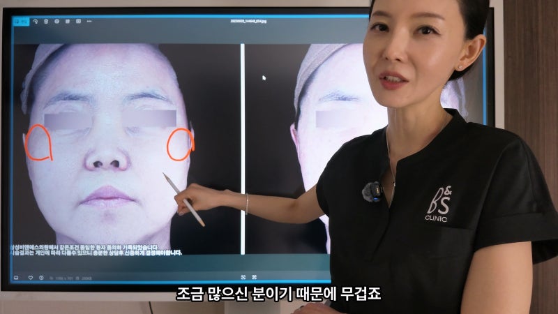 50대 팔자주름과 마리오넷 라인, 쥬브젠과 실리프팅을 함께 고려한 이유