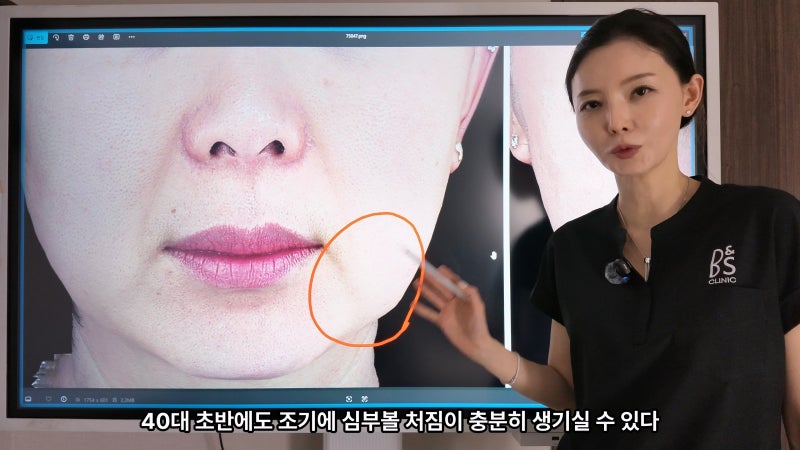 주름지우는 의사 박소현원장 쥬브젠 실리프팅 시술 철학 (삼성비앤에스의원) 사진 8