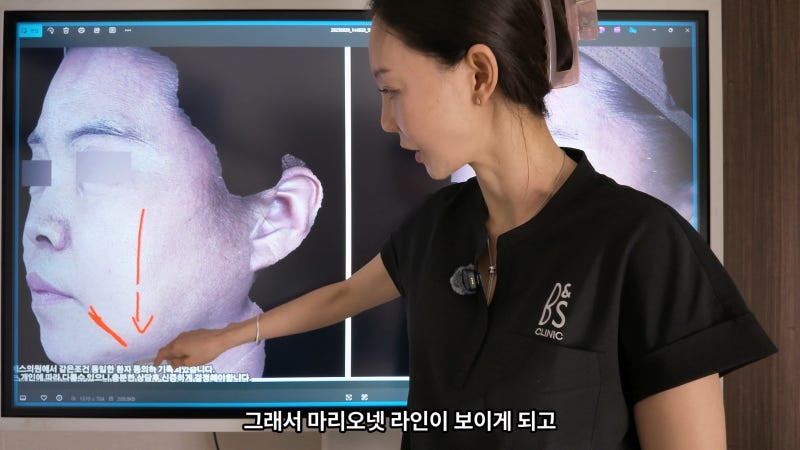 주름지우는 의사 박소현원장 쥬브젠 실리프팅 시술 철학 (삼성비앤에스의원) 사진 5