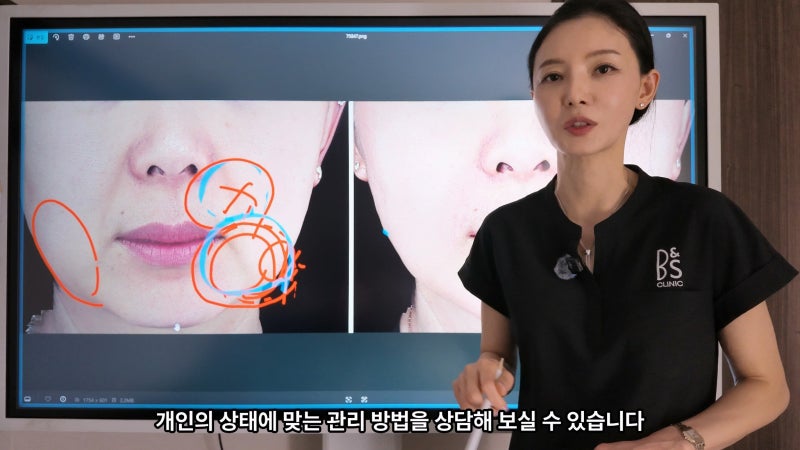 주름지우는 의사 박소현원장 쥬브젠 실리프팅 시술 철학 (삼성비앤에스의원)