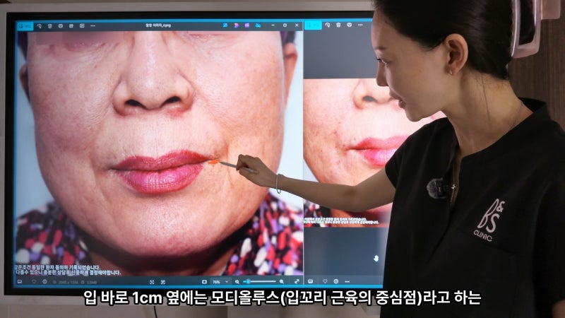주름지우는 의사 박소현원장 쥬브젠 실리프팅 시술 철학 (삼성비앤에스의원) 사진 9