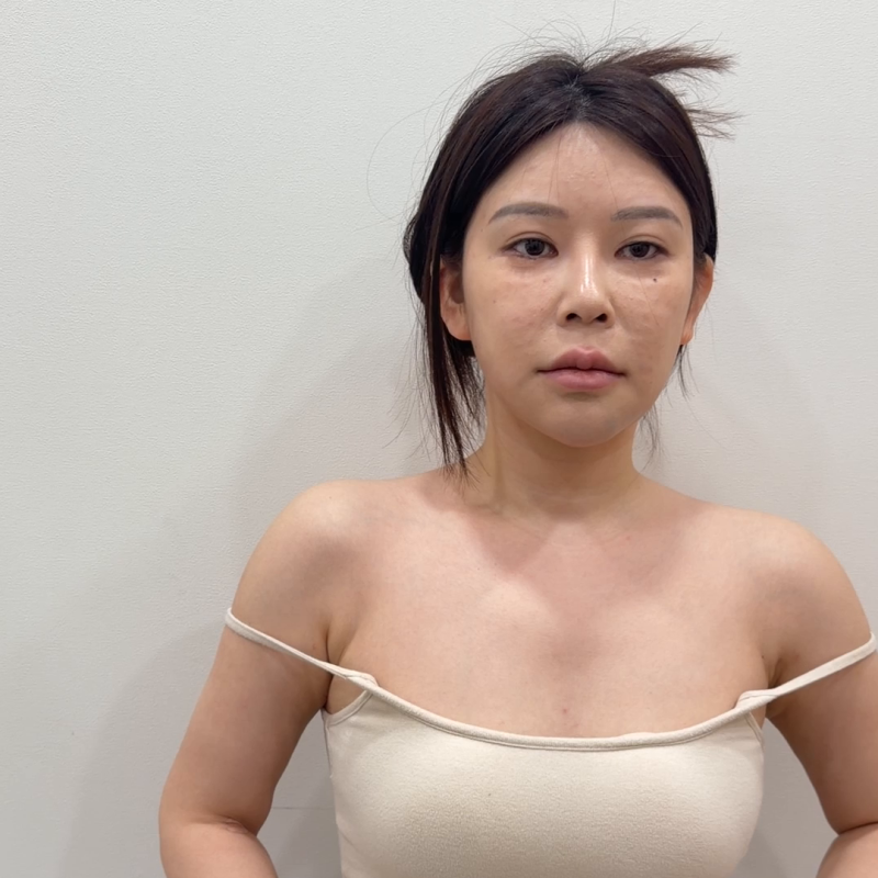 합정 어깨필러, 좁고 처져 보이는 어깨 라인은 어떻게 달라질까요?