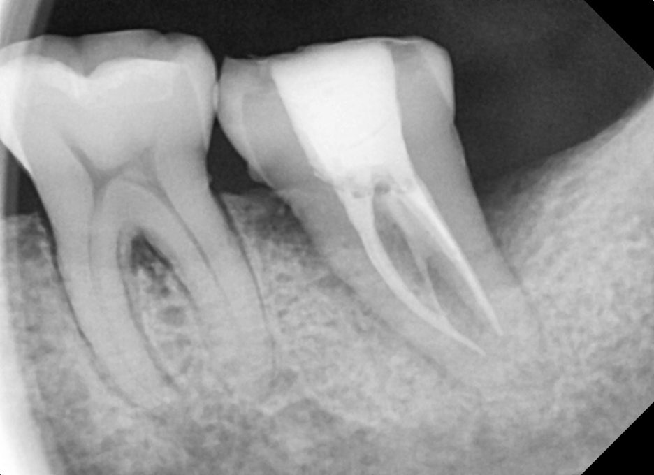 Yaksu-dong Dental Clinic: Why You Shouldn't Postpone Cavity Treatment 사진 9
