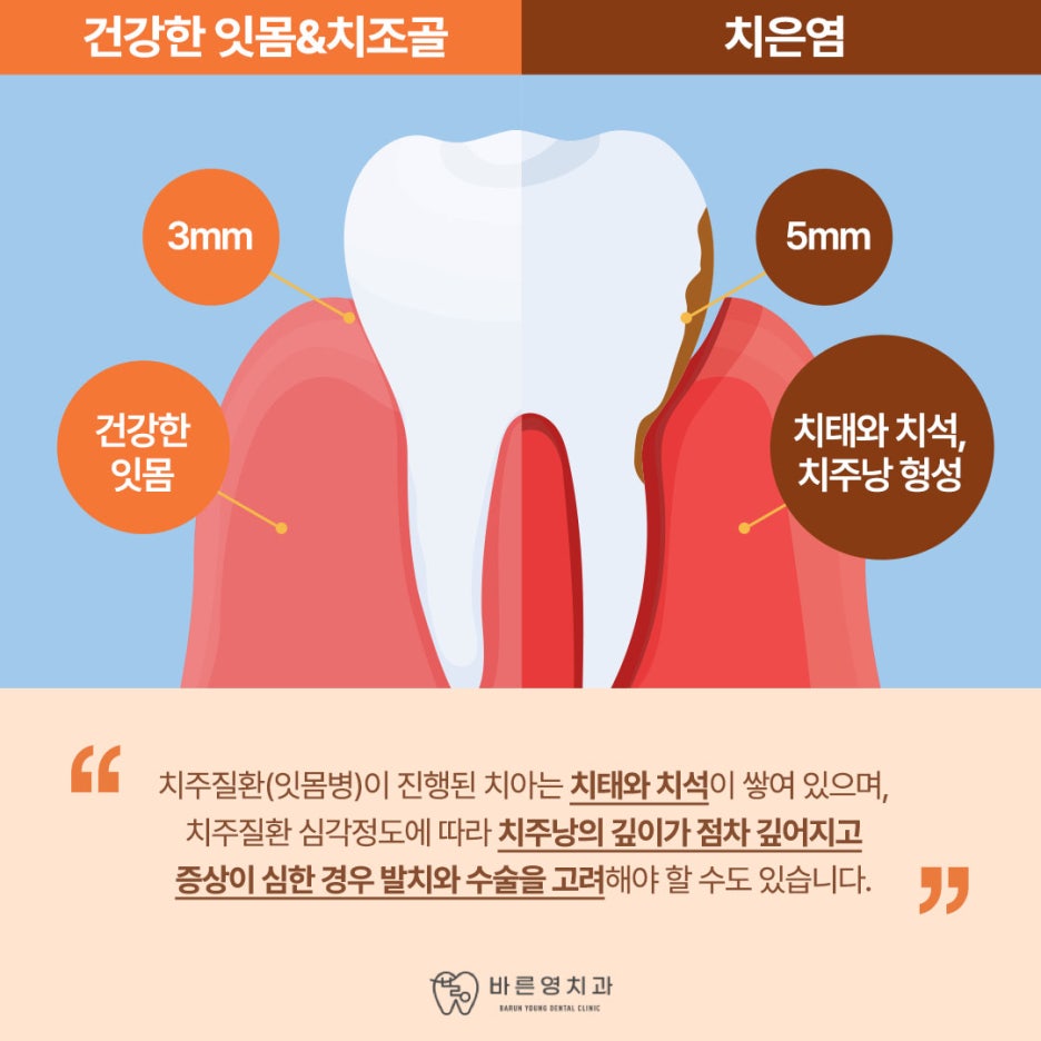 서울중구치과, 잇몸 피 그냥 두면 위험해요 사진 3
