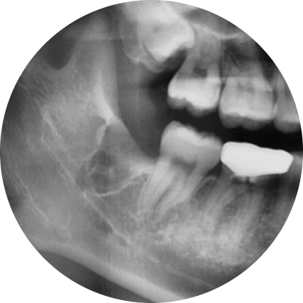 Oksu Station Dental Clinic: Wisdom Tooth Extraction Requires Post-Procedure Care 사진 6