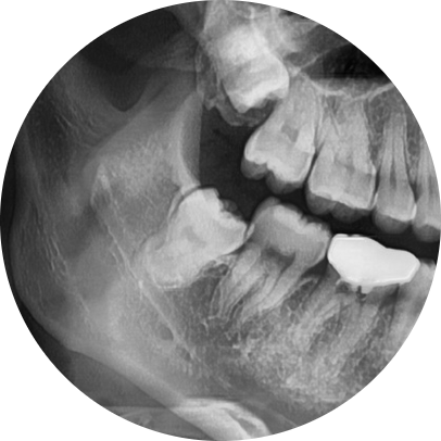 Oksu Station Dental Clinic: Wisdom Tooth Extraction Requires Post-Procedure Care 사진 5