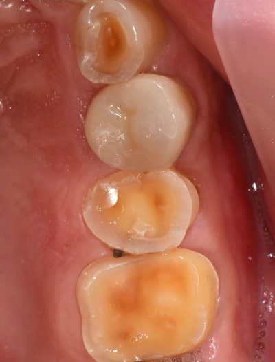 Yaksu Station Dental Clinic: Cracked Teeth 사진 5