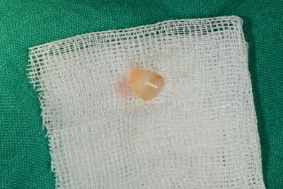 Yaksu Station Dental Clinic: Cracked Teeth 사진 2