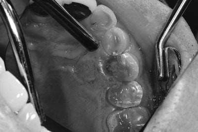 Yaksu Station Dental Clinic: Cracked Teeth 사진 3