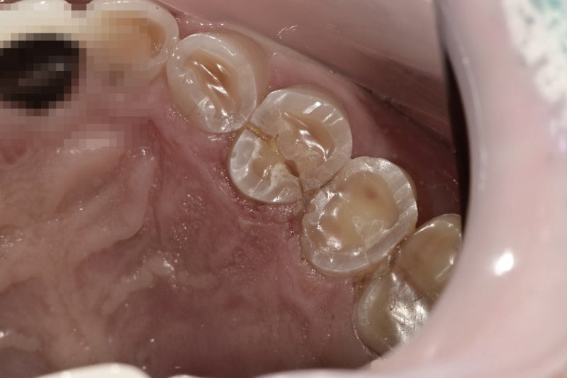Yaksu Station Dental Clinic: Cracked Teeth
