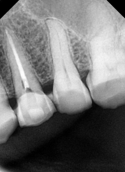 Yaksu Station Dental Clinic: Cracked Teeth 사진 4